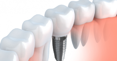 dental implants cleveland